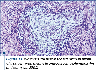 Figure 13. Walthard cell nest in the left ovarian hilum of a patient with uterine leiomyosarcoma (Hematoxylin and eosin, ob. 200X)