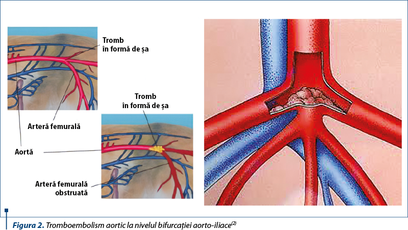 Figura 2. Tromboembolism aortic la nivelul bifurcaţiei aorto-iliace(2)