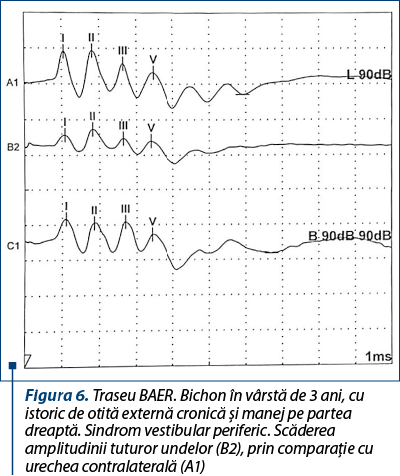 Figura 6. Traseu BAER. Bichon în vârstă de 3 ani, cu istoric de otită externă cronică şi manej pe partea dreaptă. Sindrom vestibular periferic. Scăderea amplitudinii tuturor undelor (B2), prin comparaţie cu urechea contralaterală (A1)