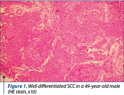 Figure 1. Well differentiated SCC in a 49-year-old male (HE stain, x10)