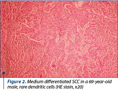 Figure 2. Medium differentiated SCC in a 69-year-old male, rare dendritic cells (HE stain, x20)