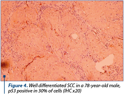 Figure 4. Well differentiated SCC in a 78-year-old male, p53 positive in 30% of cells (IHC x20)