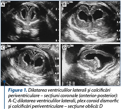 Figura 1. Dilatarea ventriculilor laterali şi calcificări periventriculare – secţiuni coronale (anterior-posterior): A-C; dilatarea ventriculilor laterali, plex coroid dismorfic şi calcificări periventriculare – secţiune oblică: D