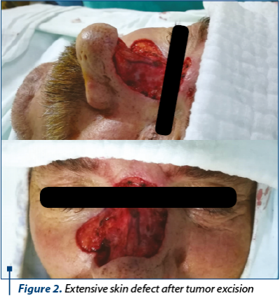 Figure 2. Extensive skin defect after tumor excision 