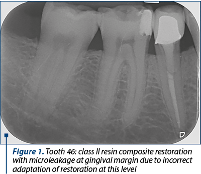 Figure 1. Tooth 46: class II resin composite restoration with microleakage at gingival margin due to incorrect adaptation of restoration at this level
