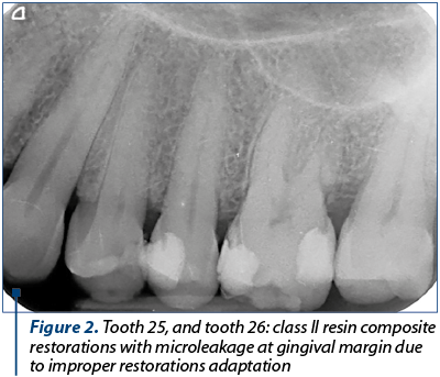 Figure 2. Tooth 25, and tooth 26: class II resin composite restorations with microleakage at gingival margin due to improper restorations adaptation