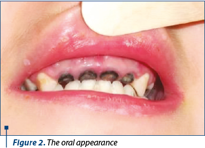 Figure 2. The oral appearance