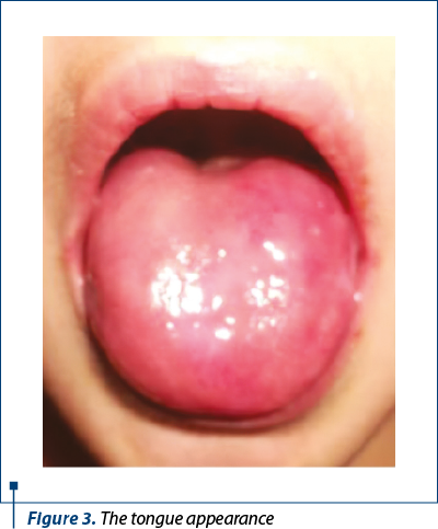 Figure 3. The tongue appearance