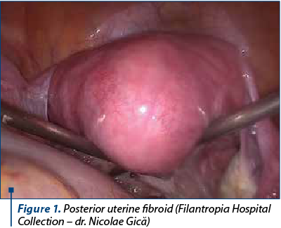 Figure 1. Posterior uterine fibroid (Filantropia Hospital Collection – dr. Nicolae Gică)