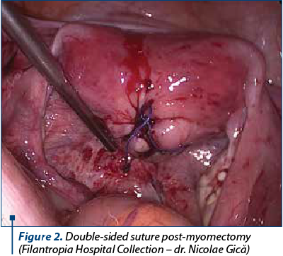 Figure 3. Double-sided suture post-myomectomy (Filantropia Hospital Collection – dr. Nicolae Gică)