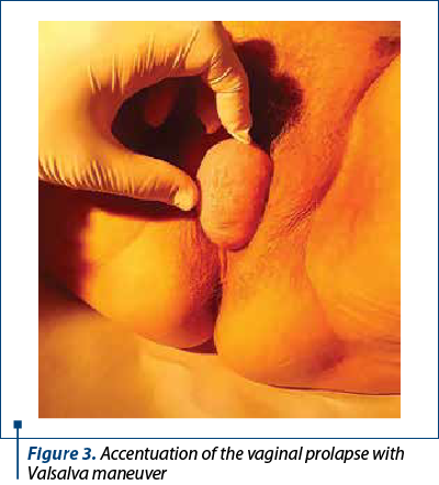Figure 3. Accentuation of the vaginal prolapse with Valsalva maneuver