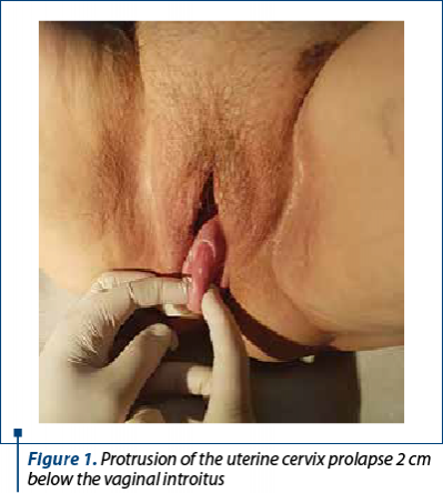 Figure 1. Protrusion of the uterine cervix prolapse 2 cm below the vaginal introitus