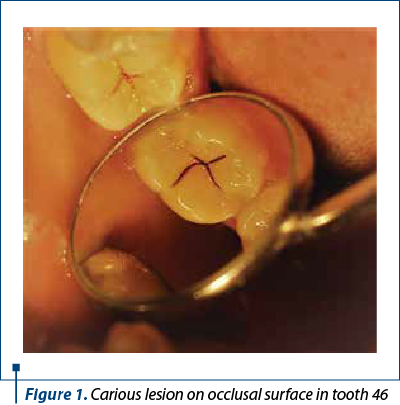 Figure 1. Carious lesion on occlusal surface in tooth 46 