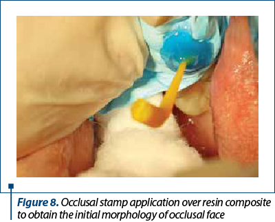 Figure 8. Occlusal stamp application over resin composite to obtain the initial morphology of occlus