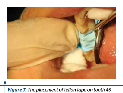 Figure 7. The placement of teflon tape on tooth 46