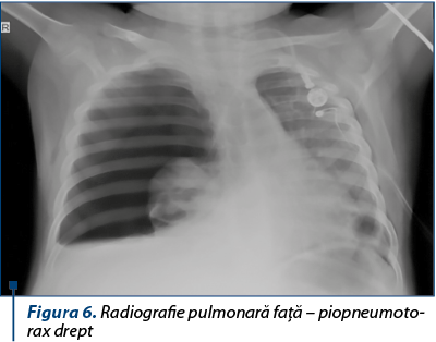 Figura 6. Radiografie pulmonară faţă – piopneumo­to­rax drept
