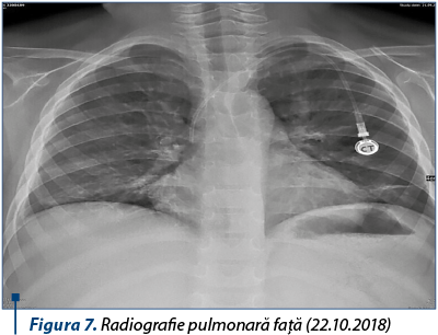 Figura 7. Radiografie pulmonară faţă (22.10.2018)