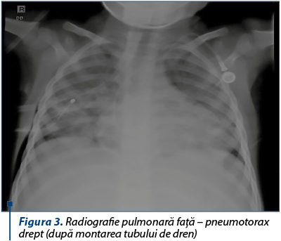 Figura 3. Radiografie pulmonară faţă – pneumotorax drept (după montarea tubului de dren)