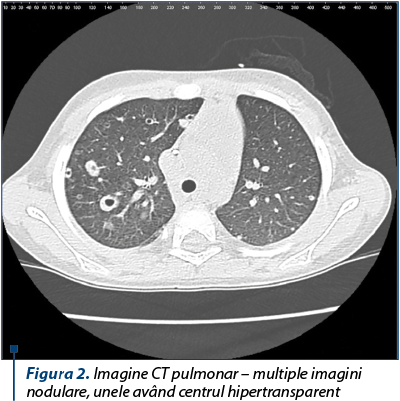 Figura 2. Imagine CT pulmonar – multiple imagini nodulare, unele având centrul hipertransparent