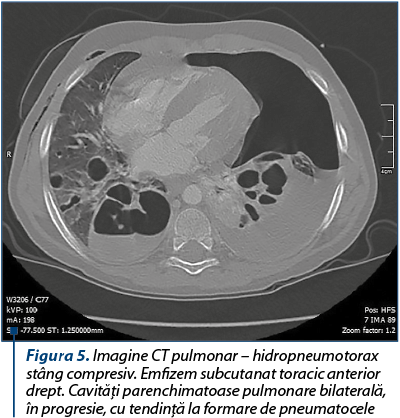 Figura 5. Imagine CT pulmonar – hidropneumotorax stâng compresiv. Emfizem subcutanat toracic anterior drept. Cavităţi parenchimatoase pulmonare bilaterală,  în progresie, cu tendinţă la formare de pneumatocele