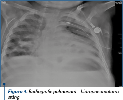 Figura 4. Radiografie pulmonară – hidropneumotorax stâng