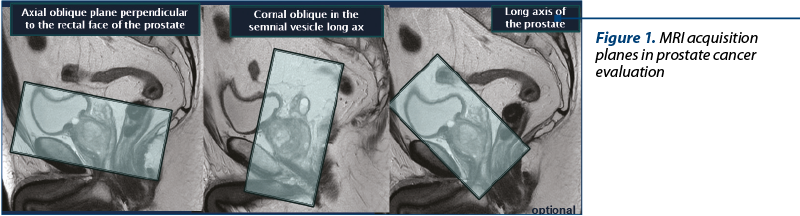 Figure 1. MRI acquisition planes in prostate cancer evaluation