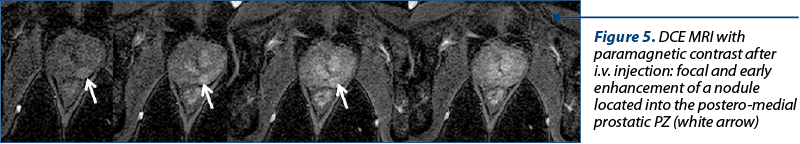 Figure 5. DCE MRI with paramagnetic contrast after i.v. injection: focal and early enhancement of a nodule located into the postero-medial prostatic PZ (white arrow)
