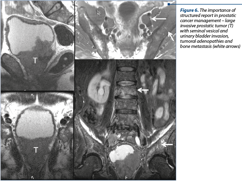 Figure 6. The importance of structured report in prostatic cancer management – large invasive prostatic tumor (T) with seminal vesical and urinary bladder invasion, tumoral adenopathies and bone metastasis (white arrows)
