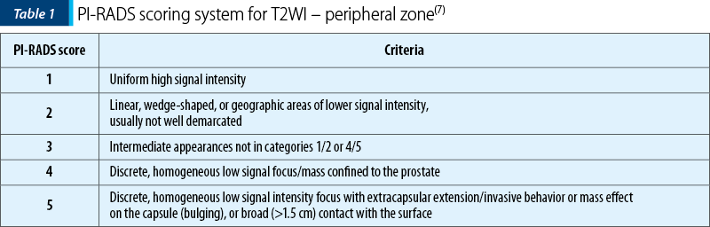 Table 1. PI-RADS scoring system for T2WI – peripheral zone(7)