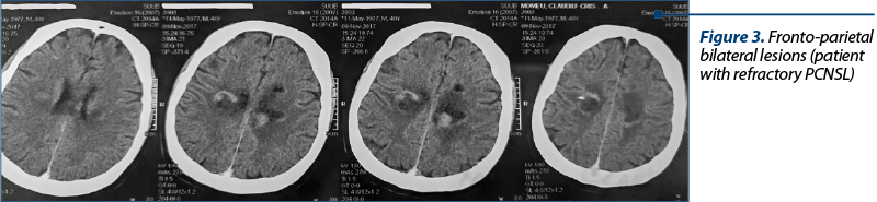 Figure 3. Fronto-parietal bilateral lesions (patient with refractory PCNSL)