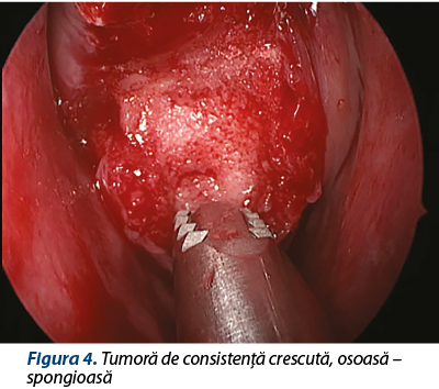 Figura 4. Tumoră de consistenţă crescută, osoasă – spongioasă