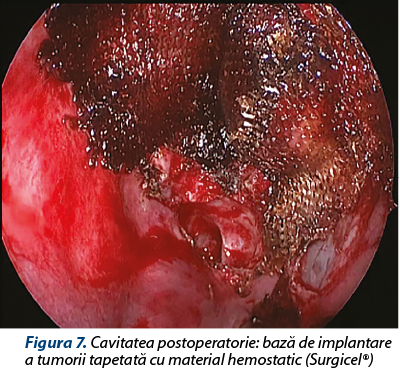 Figura 7. Cavitatea postoperatorie: bază de implantare a tumorii tapetată cu material hemostatic (Surgicel®)