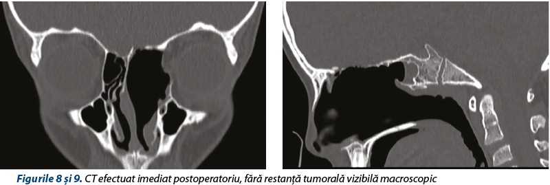 Figurile 8 şi 9. CT efectuat imediat postoperatoriu, fără restanţă tumorală vizibilă macroscopic