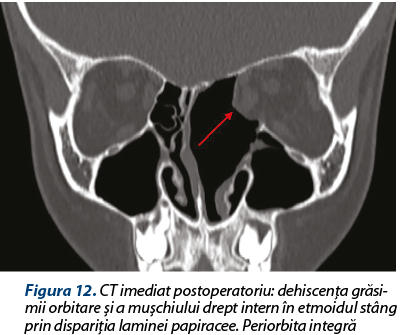 Figura 12. CT imediat postoperatoriu: dehiscenţa gră­si­mii orbitare şi a muşchiului drept intern în etmoidul stâng prin dispariţia laminei papiracee. Periorbita integră