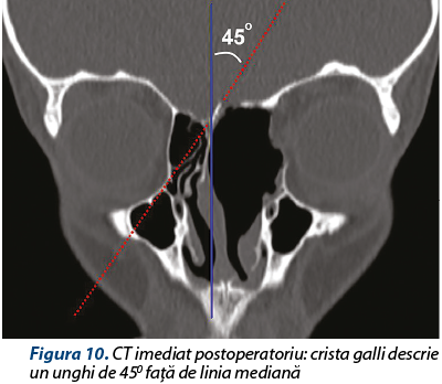 Figura 10. CT imediat postoperatoriu: crista galli descrie un unghi de 450 faţă de linia mediană 