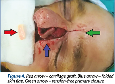 Figure 4. Red arrow – cartilage graft. Blue arrow – folded skin flap. Green arrow – tension-free pri