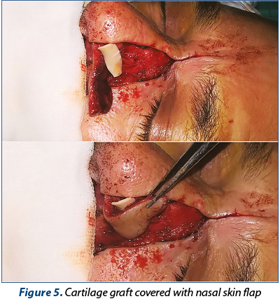 Figure 5. Cartilage graft covered with nasal skin flap