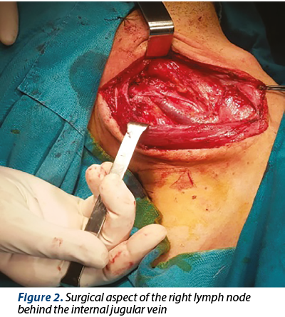 Figure 2. Surgical aspect of the right lymph node behind the internal jugular vein