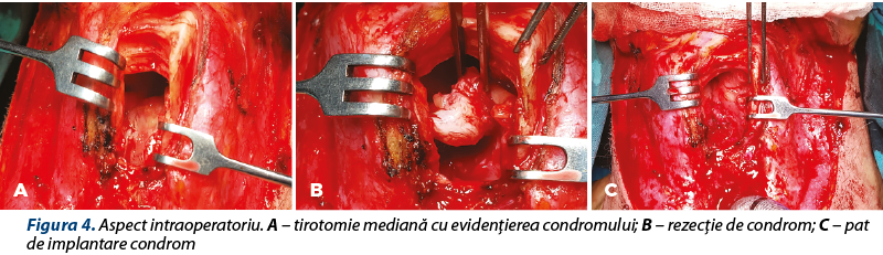 Figura 4. Aspect intraoperatoriu. A – tirotomie mediană cu evidenţierea condromului; B – rezecţie de
