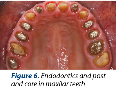 Figure 6. Endodontics and post and core in maxilar teeth