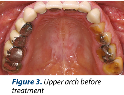 Figure 3. Upper arch before treatment