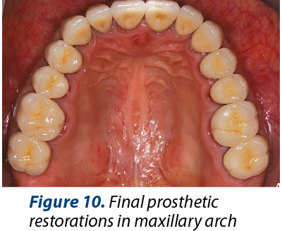 Figure 10. Final prosthetic restorations in maxillary arch