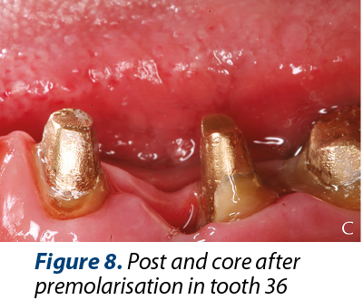 Figure 8. Post and core after premolarisation in tooth 36