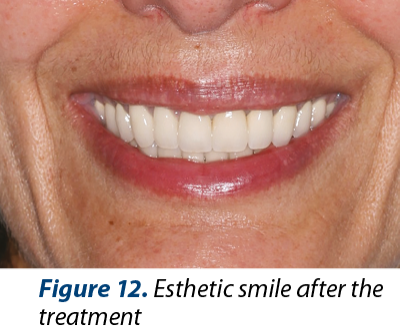 Figure 12. Esthetic smile after the treatment