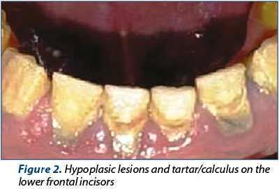 Figure 2. Hypoplasic lesions and tartar calculus on the lower frontal incisors