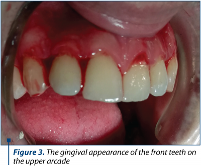 Figure 3. The gingival appearance of the front teeth on the upper arcade