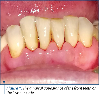 Figure 1. The gingival appearance of the front teeth on the lower arcade