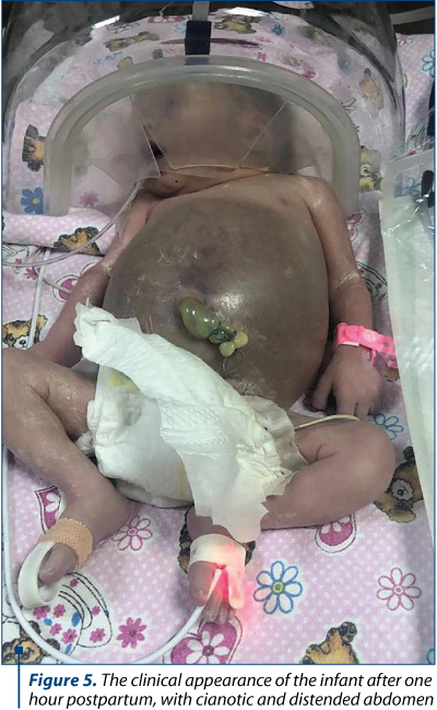 Figure 5. The clinical appearance of the infant after one hour postpartum, with cianotic and distended abdomen