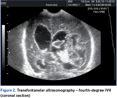 Figure 2. Transfontanelar ultrasonography – fourth-degree IVH (coronal section) 