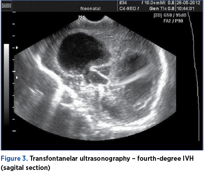 Figure 3. Transfontanelar ultrasonography – fourth-degree IVH (sagital section) 